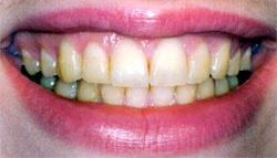 Close-up of smile showing yellowed and discolored teeth with visible plaque buildup.
