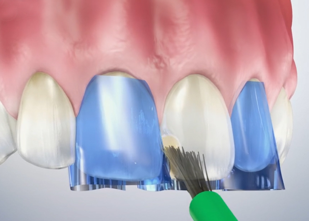 Dental model showing tooth whitening comparison between natural and bleached teeth with brush application.