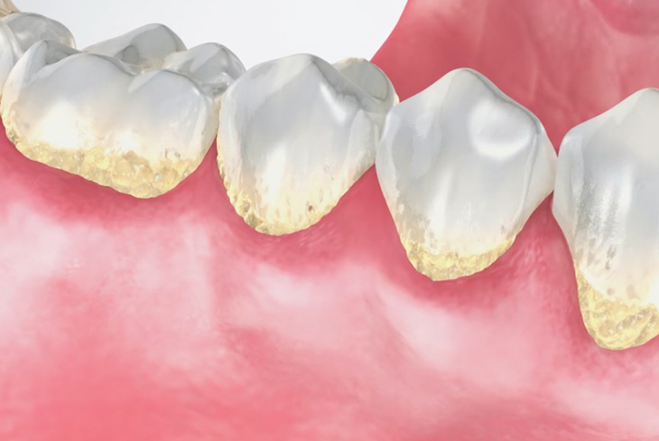 Dental illustration showing tooth decay progression on teeth with exposed dentin and gum recession.