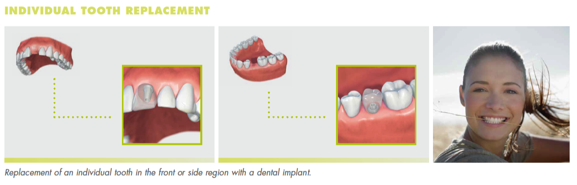 Dental professional demonstrating individual tooth replacement options and implant procedures in clinical setting.