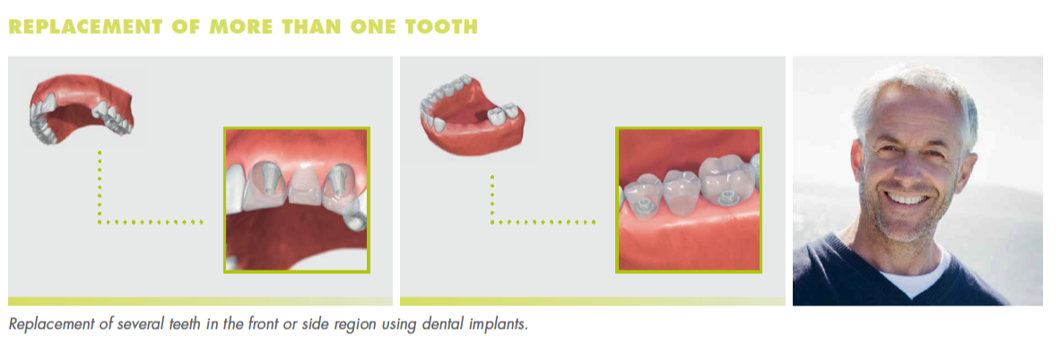 Dental implant procedure steps showing tooth replacement comparison with smiling patient portrait.