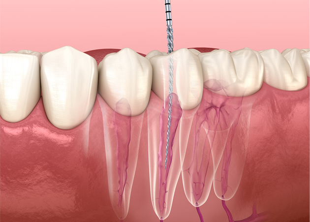 Dental diagram showing teeth and root canal anatomy with pink gum tissue illustration.