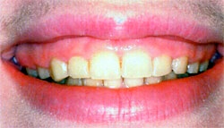 Close-up of discolored and misaligned teeth showing yellow staining and spacing issues