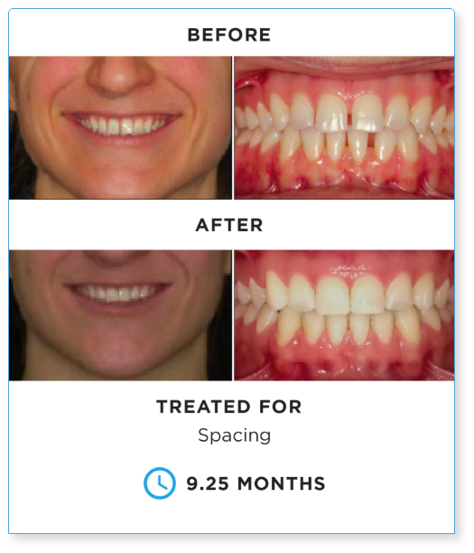 Dental before and after comparison showing smile and teeth spacing correction over 9.25 months treatment.