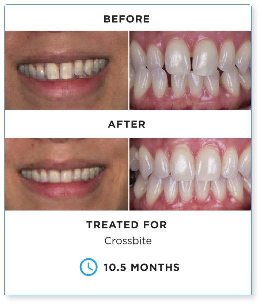 Dental before and after comparison showing smile and teeth improvement after 10.5 months of crossbite treatment.