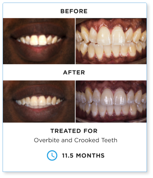 Before and after dental treatment showing corrected overbite and crooked teeth over 11.5 months.