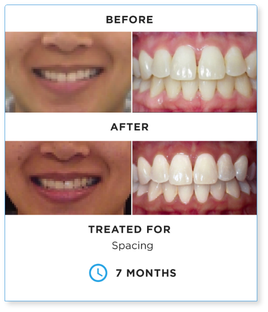 Dental spacing treatment before and after results showing tooth alignment improvement over 7 months.