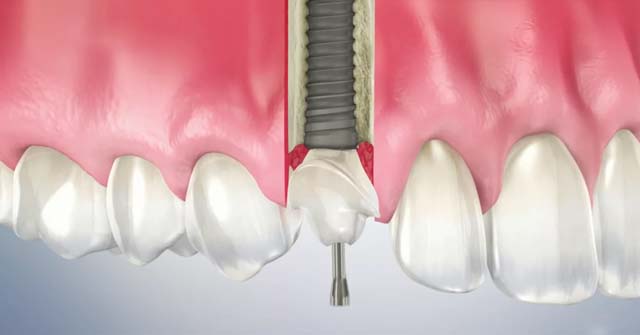 Dental implant diagram showing titanium post inserted into jawbone with surrounding teeth and gum tissue.
