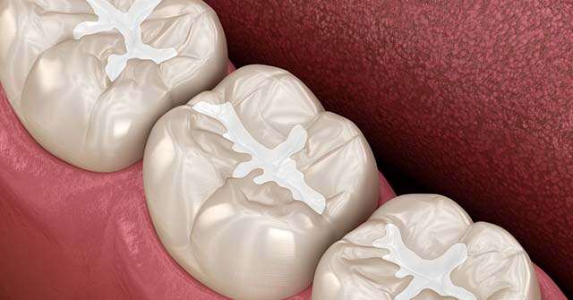 Three dental crowns displayed on pink background showing restoration details and surface texture.