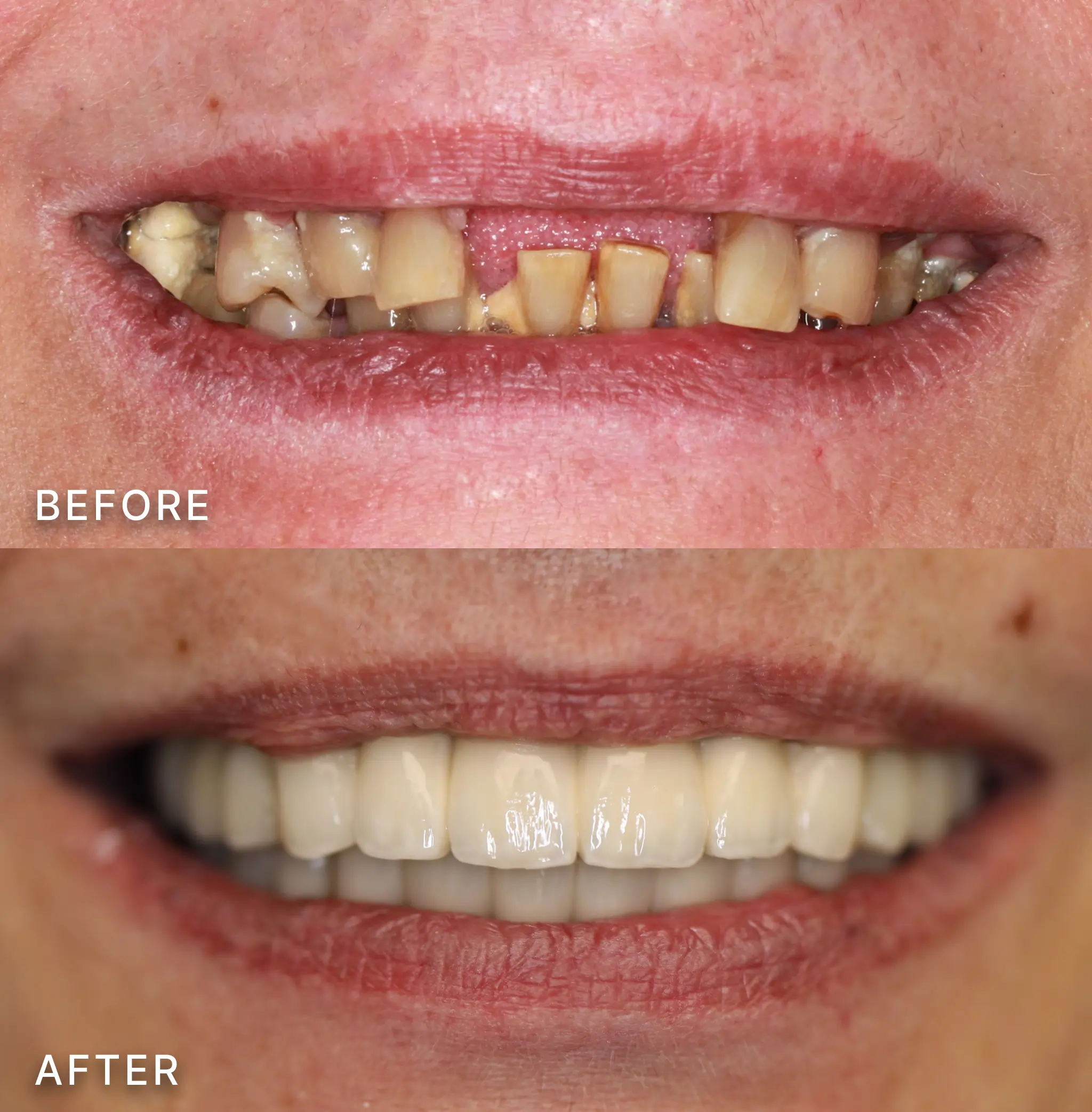 The Best Start To Finish Dental Implant Experience Available Ferguson