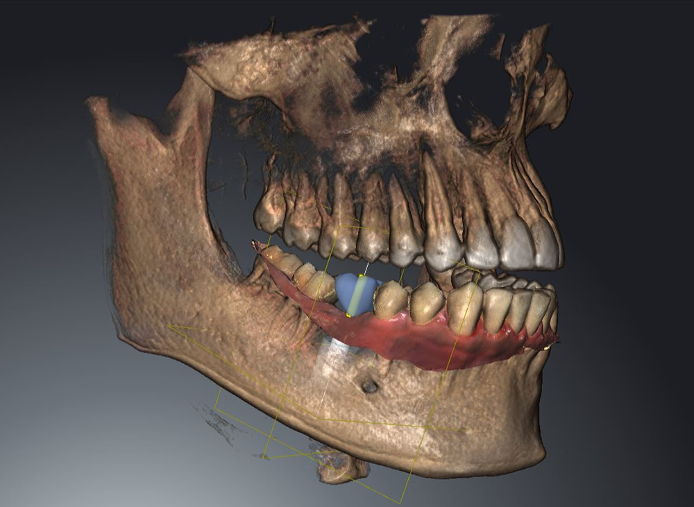 Anatomical dental model showing colored teeth and jaw structure for educational purposes.