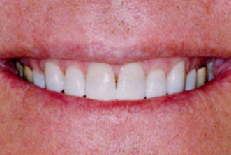 Close-up of a person's smile showing white teeth and pink lips against skin.