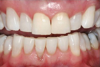 Close-up view of upper and lower teeth showing dental alignment and whiteness in clinical setting.