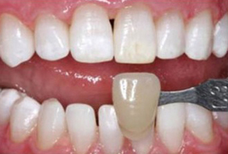 Dental veneer shade matching comparison showing tooth color samples during cosmetic dentistry consultation.