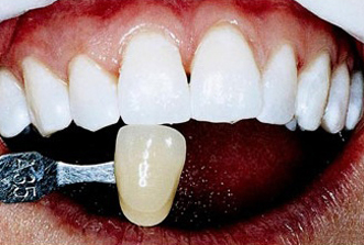 Close-up of dental veneer shade matching against natural teeth during cosmetic dentistry consultation.