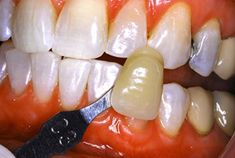 Dental professional applying whitening gel to patient's teeth during cosmetic whitening treatment.