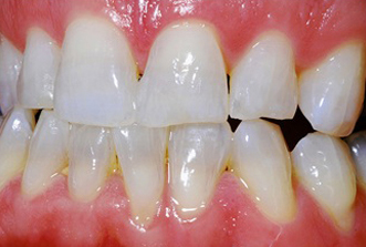 Close-up dental photograph showing upper and lower teeth with visible gaps and discoloration requiring orthodontic treatment.