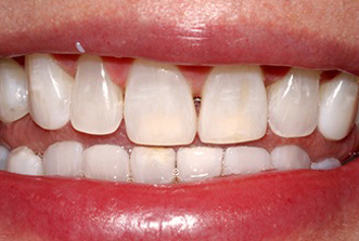 Close-up of a person's smile showing white teeth and red lips in a dental context.