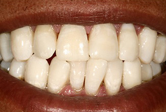 Close-up of a patient's smile showing upper and lower teeth after dental treatment.