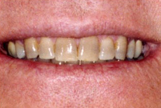 Close-up of upper teeth showing discoloration and wear, dental health concern.