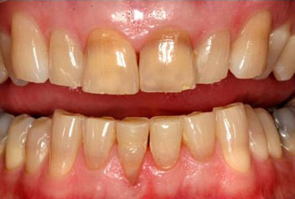 Close-up view of upper and lower teeth showing natural tooth color and dental alignment in mouth.