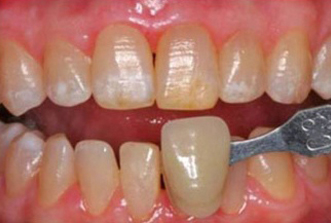 Close-up dental photograph showing upper and lower teeth with color comparison shade guide during examination.