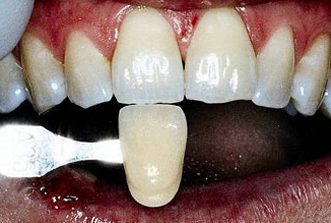Close-up view of upper and lower front teeth showing dental crowns and restorations in clinical setting.