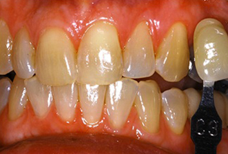 Close-up view of upper and lower teeth showing dental work and natural tooth coloration during examination.