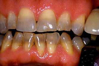 Close-up of discolored and stained teeth showing dental health concerns requiring professional treatment.