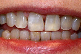 Close-up of upper and lower teeth showing natural tooth color variation and dental alignment.