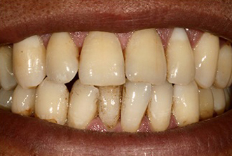 Close-up of discolored, stained teeth showing dental health concerns and discoloration.