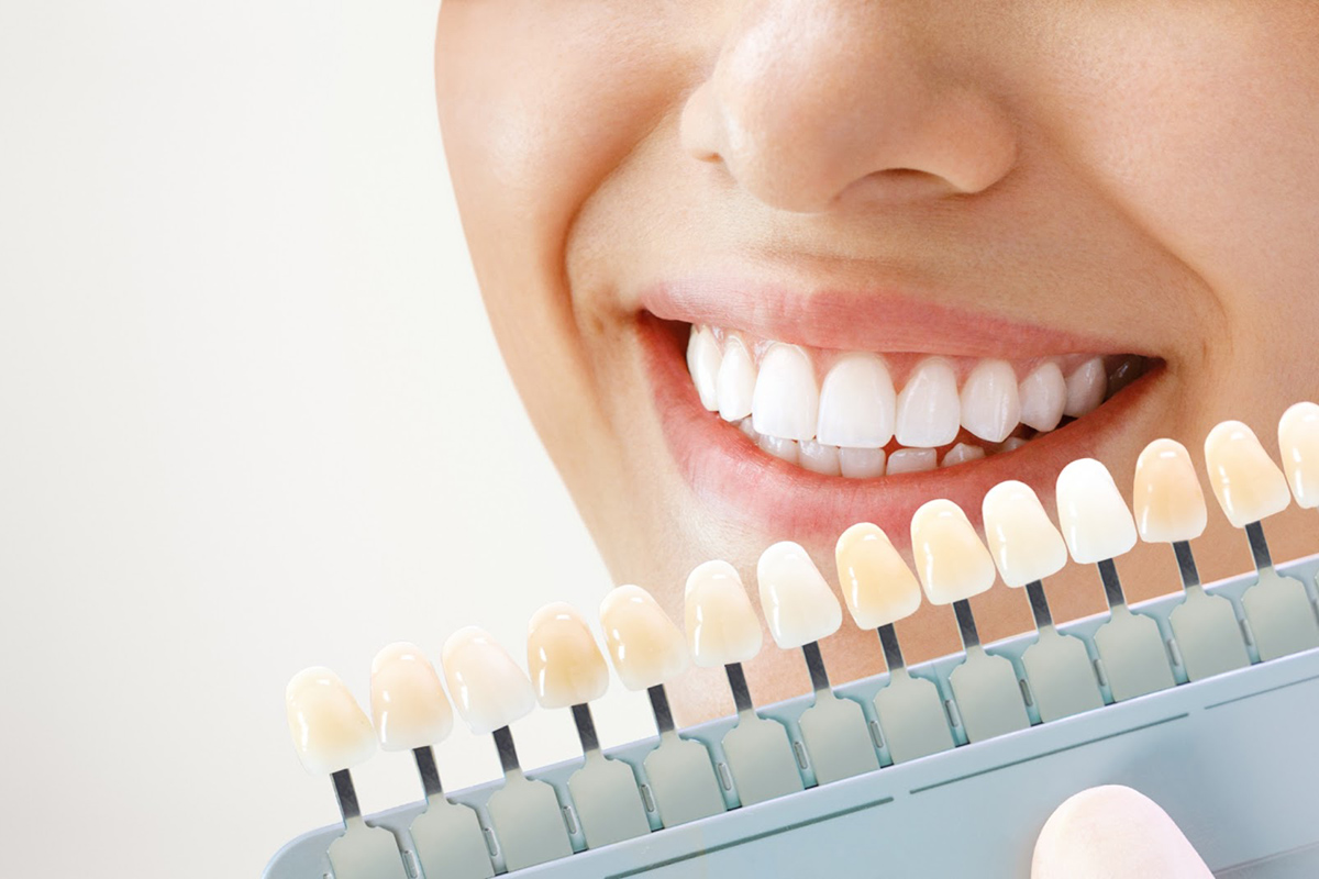 Woman smiling while comparing tooth shade guide to her teeth during dental consultation.