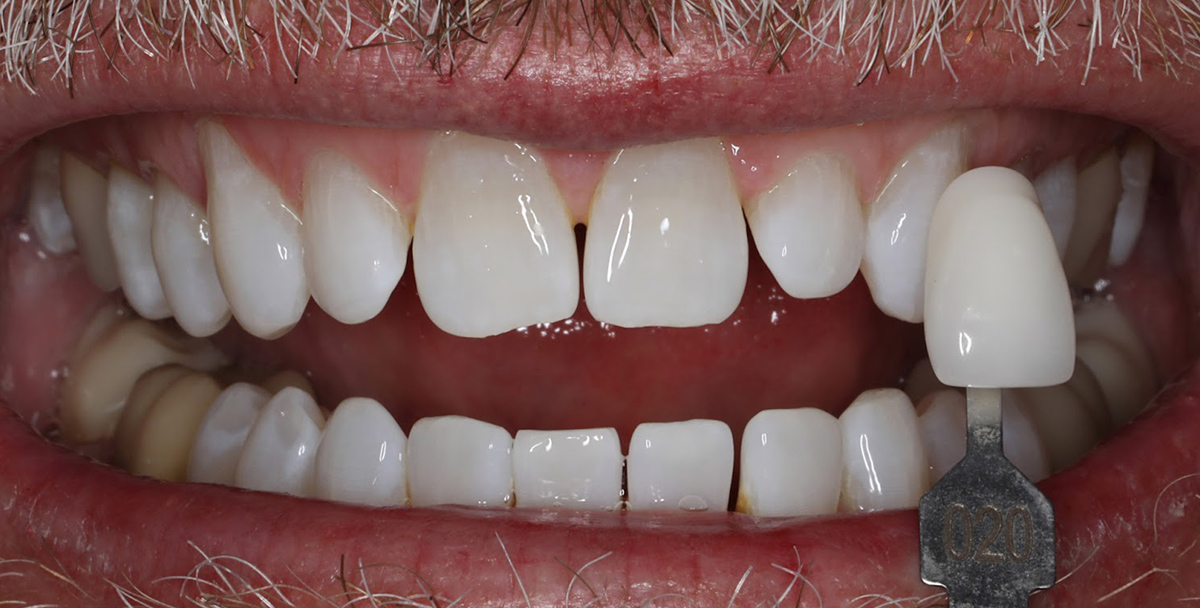 Close-up of smile showing upper and lower teeth with dental shade guide for color comparison.