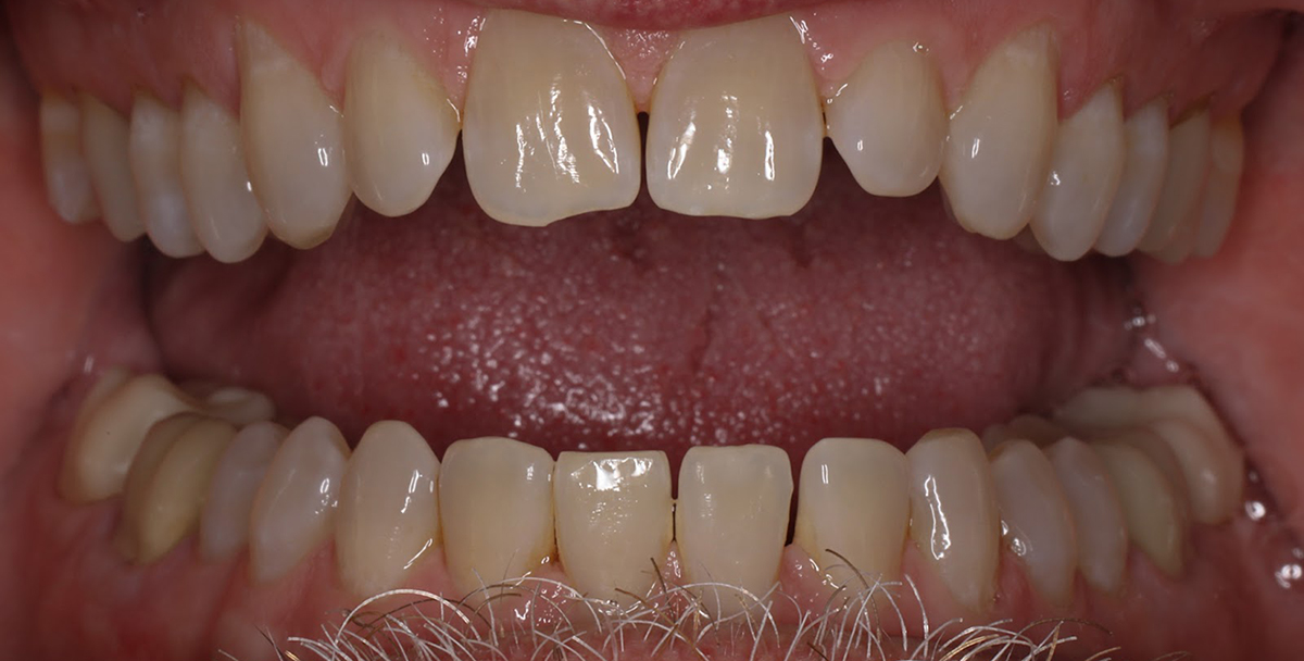 Close-up of upper and lower teeth showing dental work and tooth alignment in mouth.