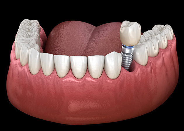 3D dental implant illustration showing tooth replacement in lower jaw with gum model