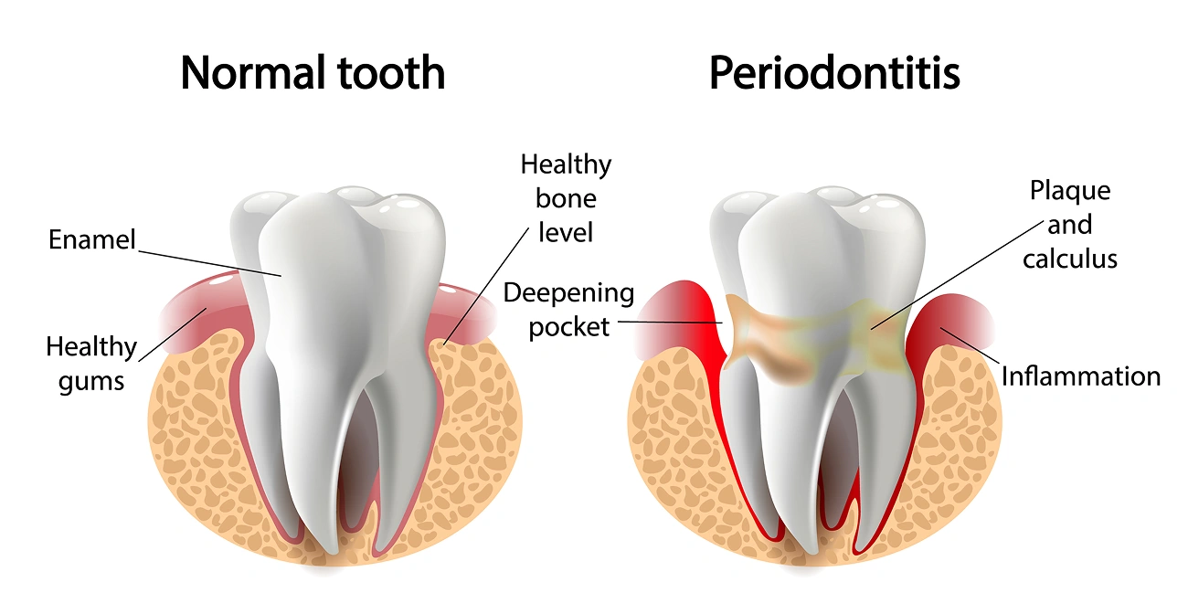 Anatomical comparison of healthy tooth versus periodontitis, showing gum disease progression and inflammation.
